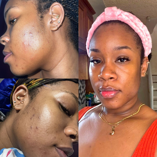 Transform Me Clear Skin Bundle